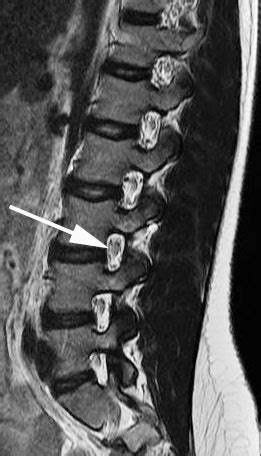 Foraminal Stenosis Mri