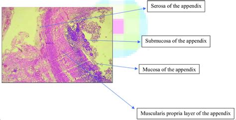 Photomicrograph of the histology slides for the index patient showing... | Download Scientific ...