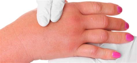 Edema - Symptoms, Causes And Other Associated Risk Factors