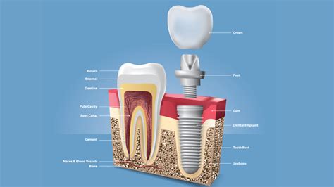 Criteria for getting endosteal dental implants | Dr. Vishwannath ...