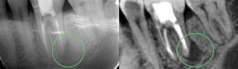 Differences | Cone Beam CT & Traditional Dental Radiography