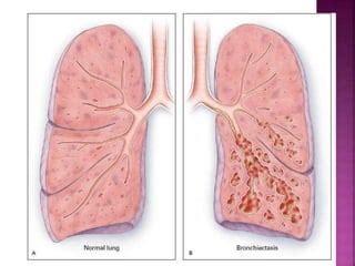 Suppurative lung diseases, Dr Inofomoh Francisca,