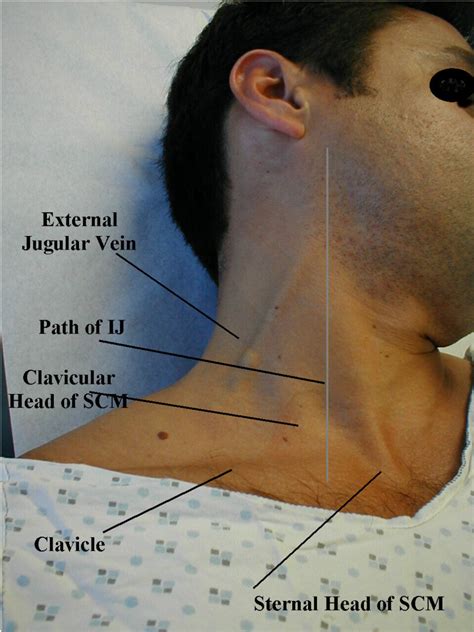 The Jugular Venous Pulse And Hepatojugular Reflux Examinations Of Cardiovascular Diseases | hubpages