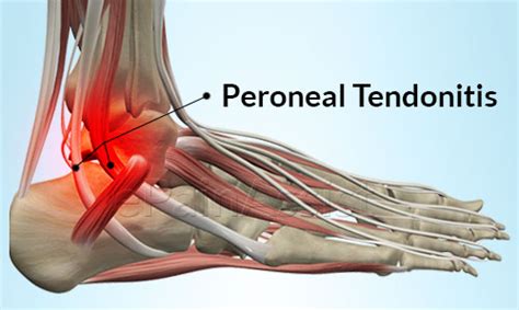 Peroneal Tendonitis Symptoms, Causes, Treatment at Home