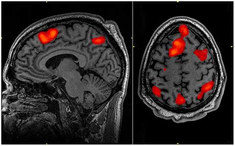 MRI Scan Detects Signs of Schizophrenia: Brain imaging test predicts likelihood of developing ...