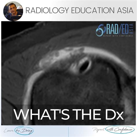 SUBACROMIAL SUBDELTOID BURSITIS MRI RADIOLOGY (VIDEO) - Radedasia