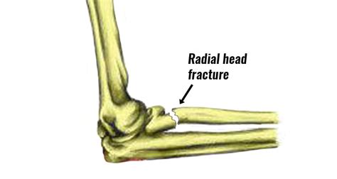 Radial Head Fracture (Elbow) - Symptoms, Causes, Treatment & Rehab