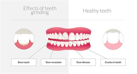 Teeth Grinding Dentist Neutral Bay | Shore Dental