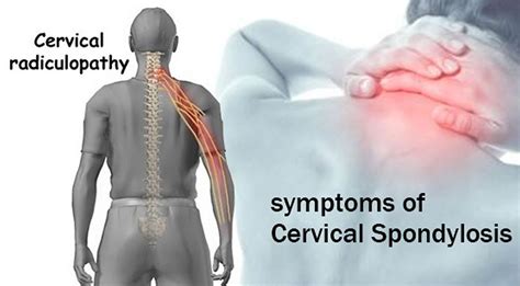 Cervical Spondylosis - Causes, Symptoms, Exercises, Treatment