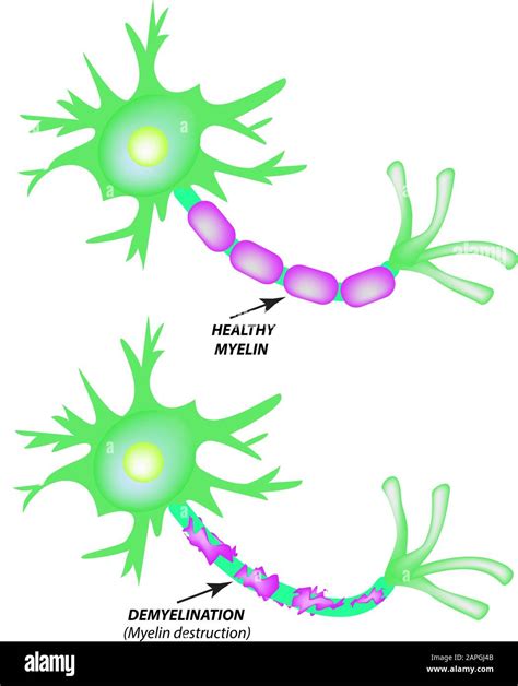 The destruction of the myelin sheath on the axon. Damaged myelin. Neuron affected by multiple ...