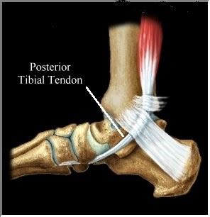 Tibialis Posterior Tendinopathy - Canberra Heel Pain Institute