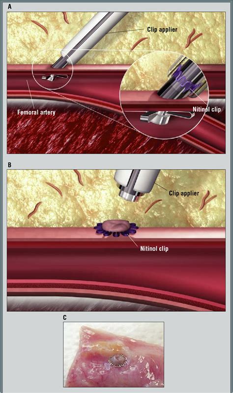 Figure 3 from Femoral artery closure after cardiac catheterization. | Semantic Scholar