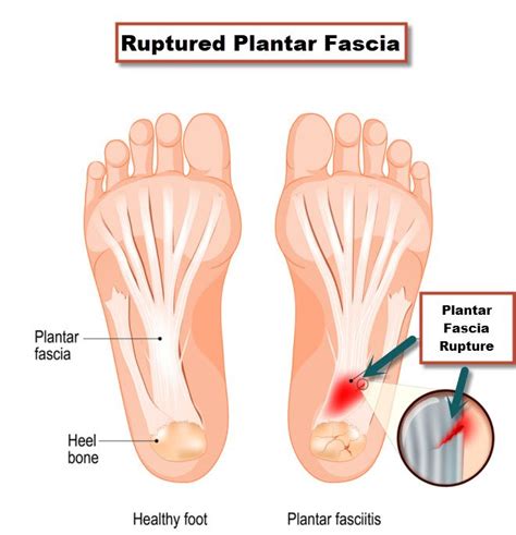 Physiopedia: The Bottom Of My Heel Hurts