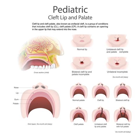 Treating Cleft Palate in Speech Therapy