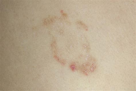 Ringworm In Humans Treatment