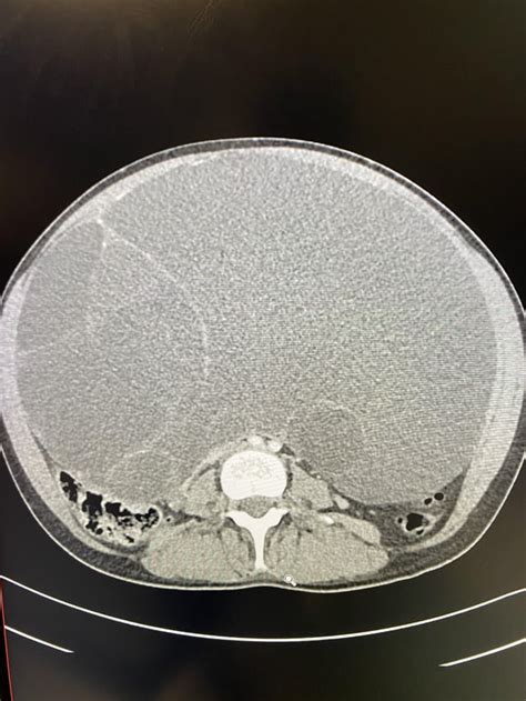 Massive Mucinous Ovarian Cancer : r/Radiology