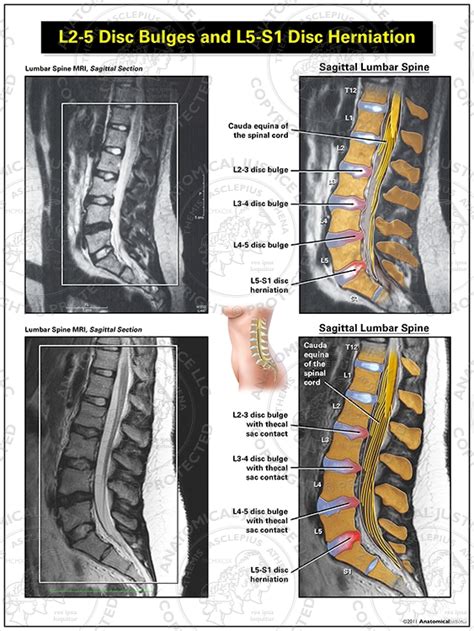 L2-5 Disc Bulges and L5-S1 Disc Herniation