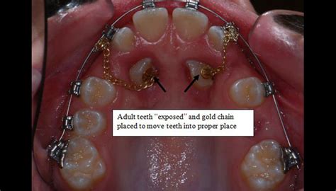 Impacted Tooth | Central Orthodontics