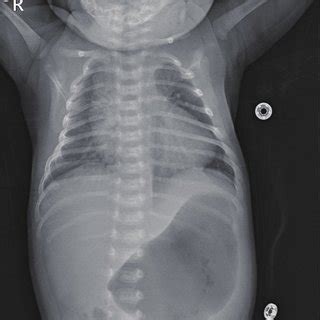 Infantogram shows cardiomegaly. It can rule out lung problems from the... | Download Scientific ...