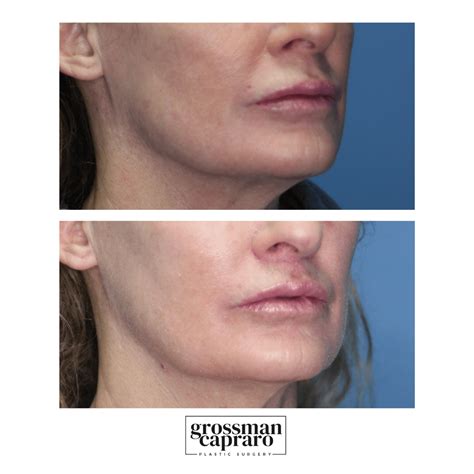 Lip Lift - Grossman Capraro Plastic Surgery