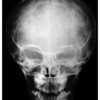 Plain skull X-ray showing a separate fracture in the left frontal... | Download Scientific Diagram