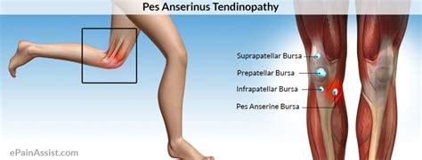 Gåsfot – Pes Anseritis Bursitis – Joggingskor.nu