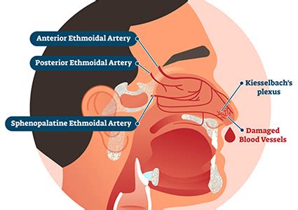 Cauterization After Surgery