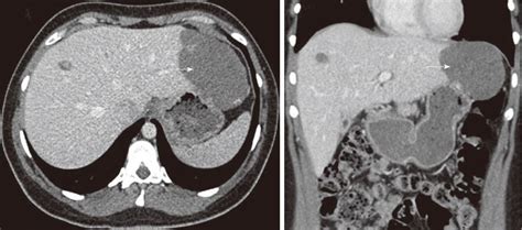 Laparoscopic resection of a giant exophytic liver haemangioma with the ...