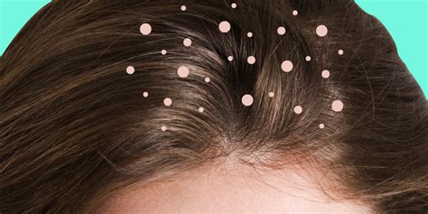 What Causes Dandruff? The Truth Behind 9 Common Dandruff Myths | SELF