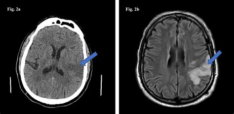 Cureus | Acute Ischemic and Hemorrhagic Stroke in COVID-19: Mounting Evidence