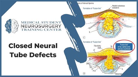 Closed Neural Tube Defects - YouTube