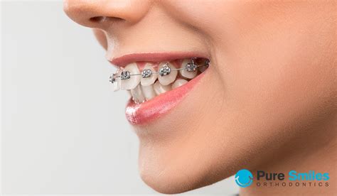 How Can Braces Correct An Overbite?