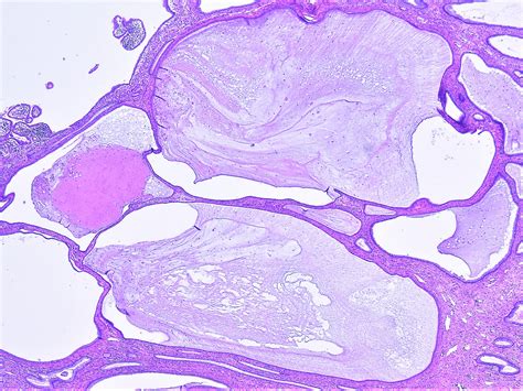 Pathology Walker@Auto Tweet Bot on Twitter: "Nabothian cyst of uterine cervix. Uterus ...