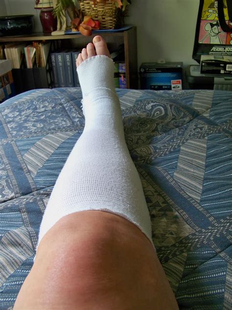 My posterior tibial tendon surgery journey: Physical therapy