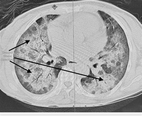 Bilateral ground glass opacities | Download Scientific Diagram