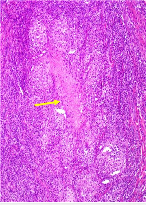 Necrotizing granuloma with epithelioid histiocytes surrounding central ...