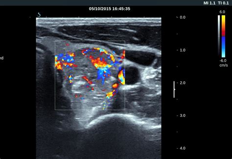 VIETNAMESE MEDIC ULTRASOUND: CASE 338: THYROID CANCER, Dr PHAN THANH HẢI, MEDIC MEDICAL CENTER ...