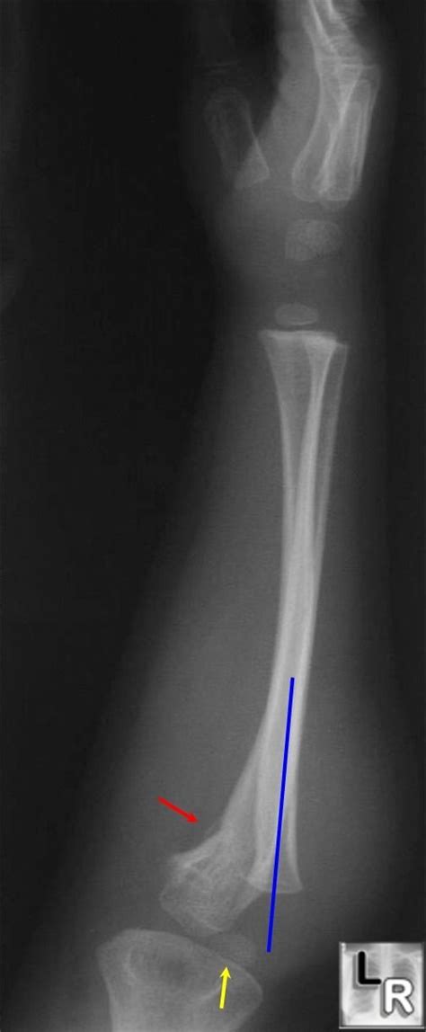 LearningRadiology.com - Galeazzi Fracture, Monteggia fracture ...