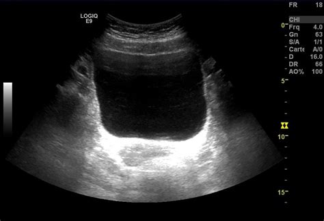 Santé: Comment se passe une échographie pelvienne