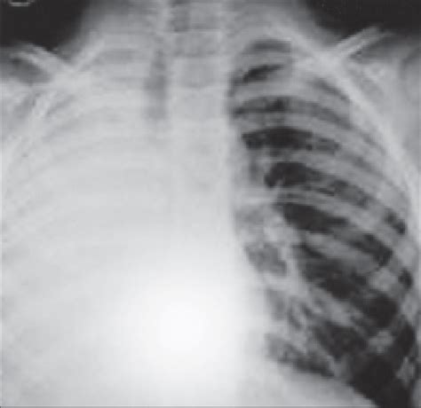 The chest x-ray 41 days after initial injury shows collapsed ...