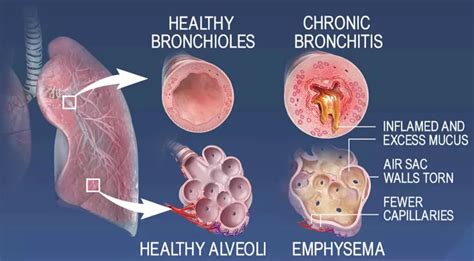 Emphysema Causes, Symptoms, Diagnosis, Treatment