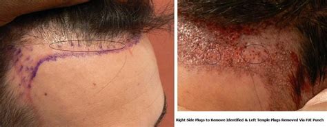 Dr.Bisanga, BHR Clinic, 2769 FUE, Hair line and Scar Repair, Plug ...