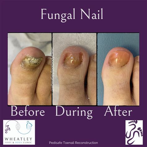 Toenail Reconstruction