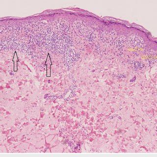 Dermatoscopy examination of the lesions showing Wickham striae clearly ...