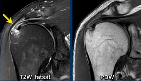 Supraspinatus Tear Mri