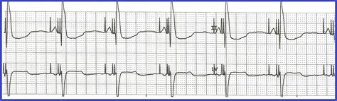 Dual Chamber Pacing Ecg | ShowBiz