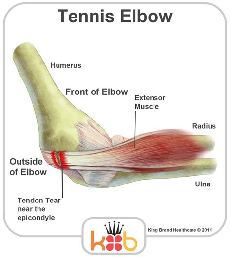 King Brand Tennis Elbow Treatment