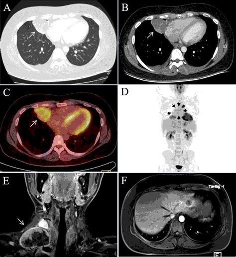 CT, PET and MRI scans showed a primary lesion in the right lung and... | Download Scientific Diagram