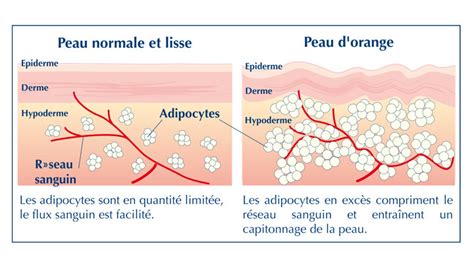 Comprendre et traiter la cellulite ou "peau d'orange"