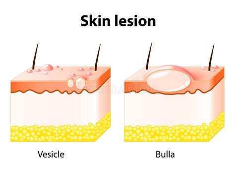 Vesicle and Bulla. Skin Lesion Stock Vector - Illustration of ...